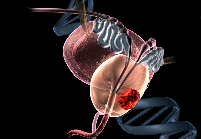 prostat kanseri 3