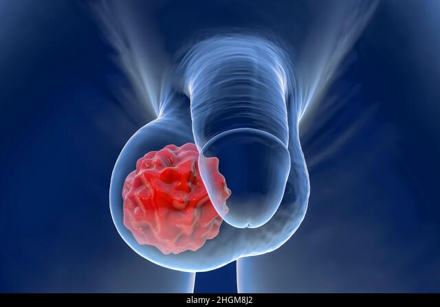 testis kanseri 1