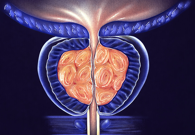 Prostate Gland - (BPH) Benign Prostatic Hyperplasia, Stage 3